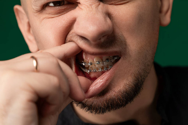 Een man met een beugel op zijn tanden maakt van zijn gezicht een onnozele uitdrukking en toont zijn tandheelkundige behandeling op een speelse manier. Zijn overdreven gelaatstrekken benadrukken het contrast tussen - Foto, afbeelding