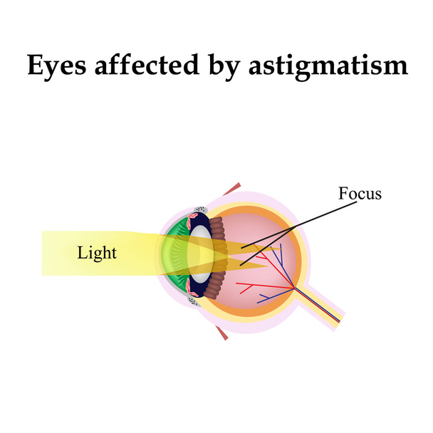 Sehstörungen mit Astigmatismus. Astigmatismus beeinträchtigt das Sehvermögen - Vektor, Bild