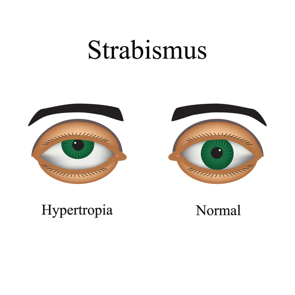 Silmän sairaudet - strabismus. Vaihtelu strabismus - Hypertropia
 - Vektori, kuva