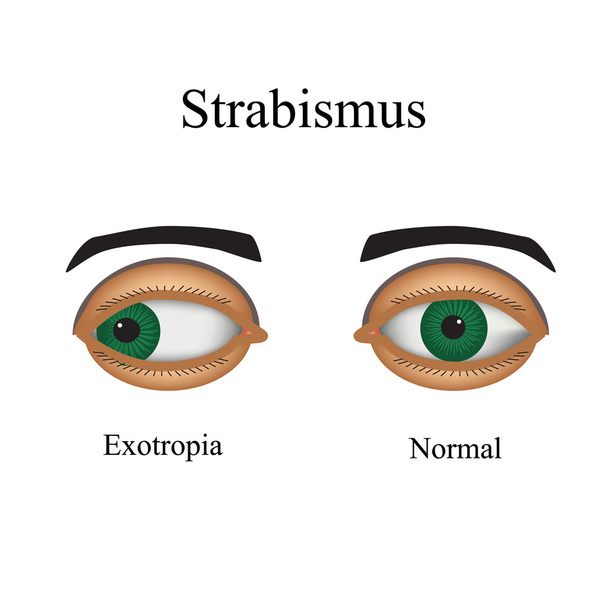 Diseases of the eye - strabismus. A variation of strabismus - Exotropia - Vector, Image