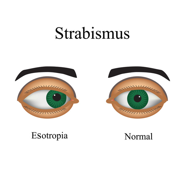 Diseases of the eye - strabismus. A variation of strabismus - Esotropia - Vector, Image