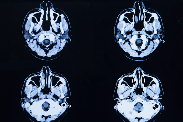 εικόνες από μια αξονική τομογραφία του εγκεφάλου και κρανίου - Φωτογραφία, εικόνα