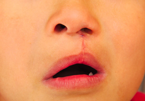 Garçon montrant une fente unilatérale lèvre réparée
. - Photo, image