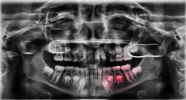 Radiographie des dents
 - Photo, image