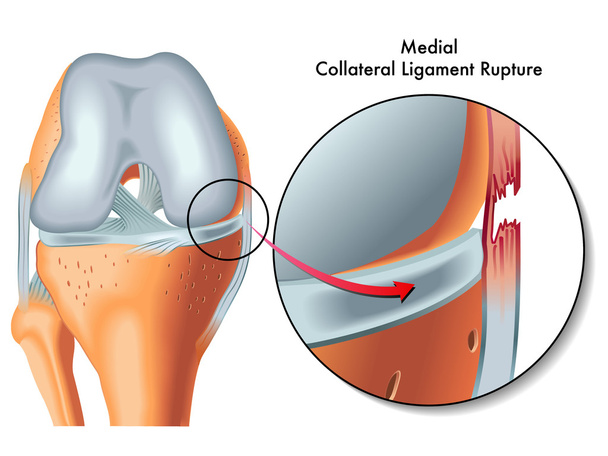 rupture ligamentaire collatérale médiane
 - Vecteur, image