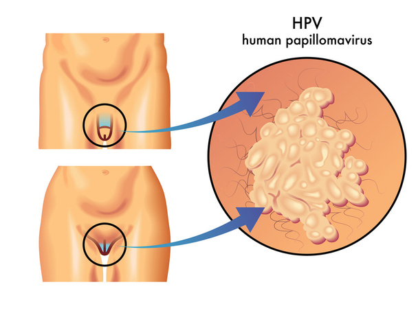 esquema de papilomavírus colorido
 - Vetor, Imagem