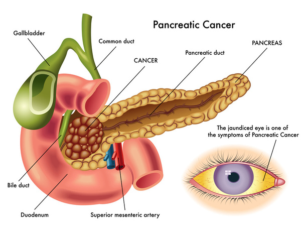 Slinivky břišní rakoviny schéma - Vektor, obrázek