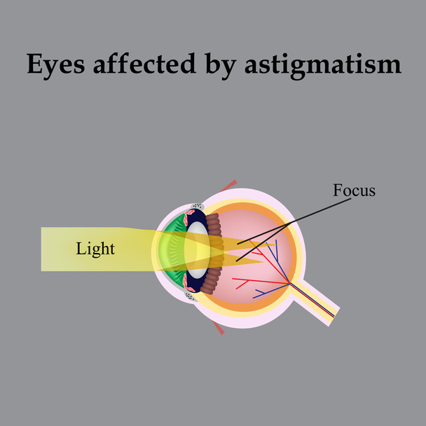 Impaired vision with astigmatism. As astigmatism affect vision - Vector, Image