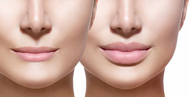 Before and after lip filler injections. - Фото, изображение