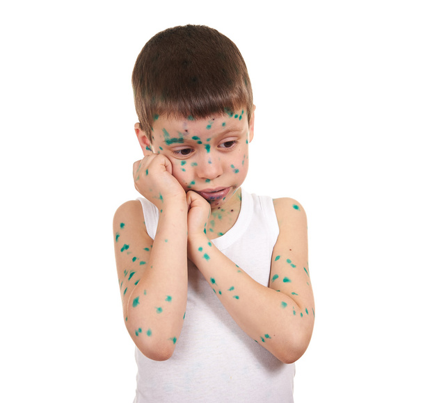 dítě má virus na kůži - Fotografie, Obrázek