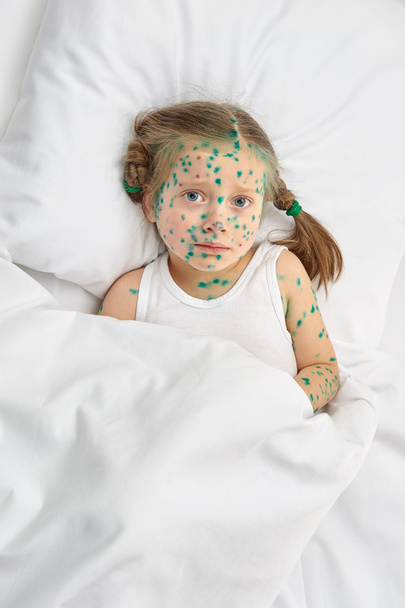 dítě má virus na kůži - Fotografie, Obrázek