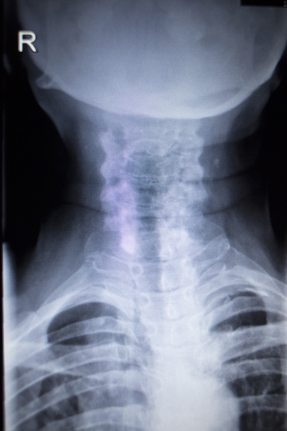 X-ray ortopedii Traumatologii skanowania obrażeniami szyi - Zdjęcie, obraz