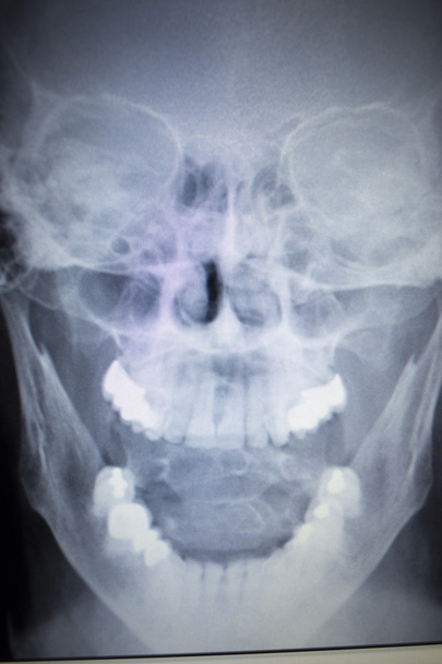 X-ray ortopedie traumatologii skenování nos újmu dýchání - Fotografie, Obrázek