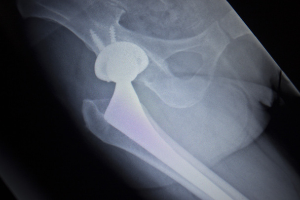 X-Ray scan afbeelding van heupgewricht vervanging orthopedische implantaat - Foto, afbeelding
