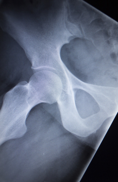 X-ray orthopedic scan  image of hip joints human skeleton - Photo, Image