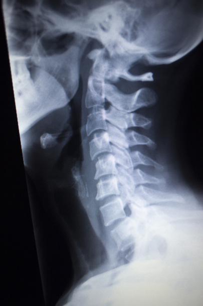 Radiografía ortopédica Traumatología de lesiones en el cuello
 - Foto, Imagen