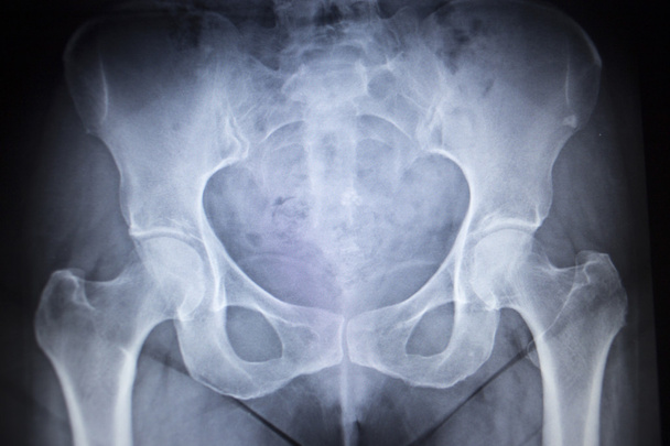 Exploración ortopédica por rayos X de las articulaciones de la cadera esqueleto humano
 - Foto, imagen