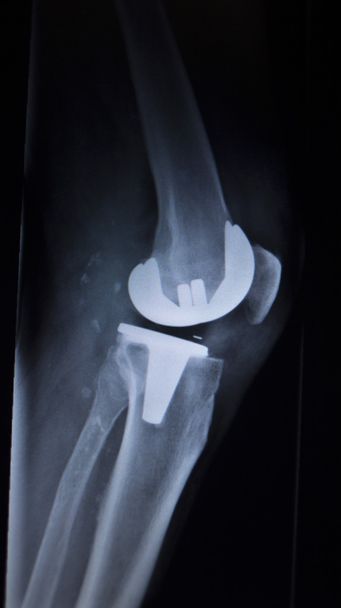 X-ray orthopedics scan of knee meniscus implant prosthetics - Photo, Image