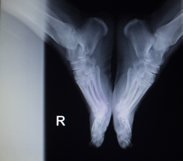 Exploración ortopédica por rayos X de lesión en el pie
  - Foto, imagen