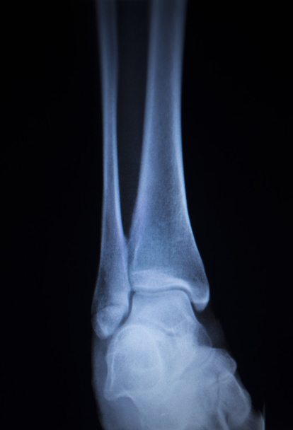Рентгенівська ортопедія сканування болючої травми щиколотки ніг
 - Фото, зображення