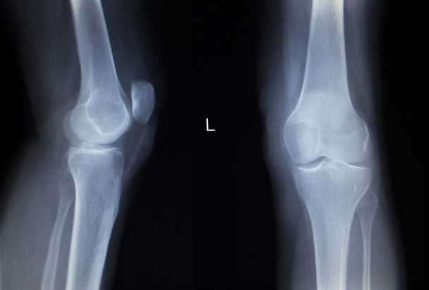 Рентген-ортопедическое сканирование болезненной травмы колена мениска ноги
 - Фото, изображение
