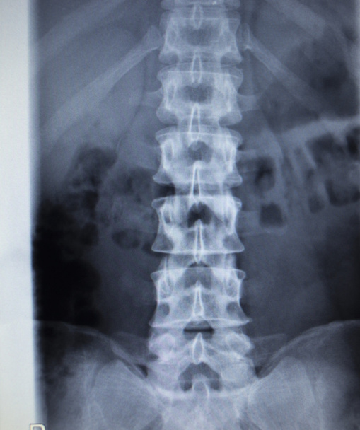 X-Ray Orthopedie traumatologie scan pijn in de rug letsel wervelkolom - Foto, afbeelding