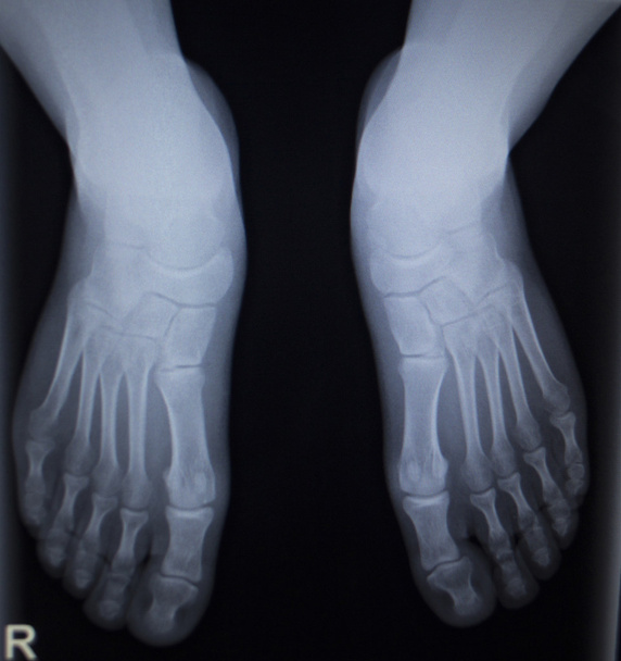 X-ray orthopedics scan of foot injury anterior posterior AP - Photo, Image