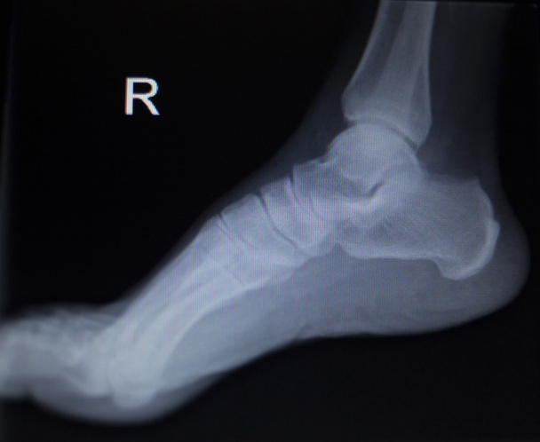 Röntgen ortopédia vizsgálat a lábfej sérülése  - Fotó, kép