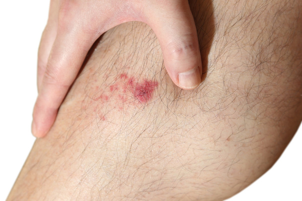 The wound on man's leg - Photo, Image