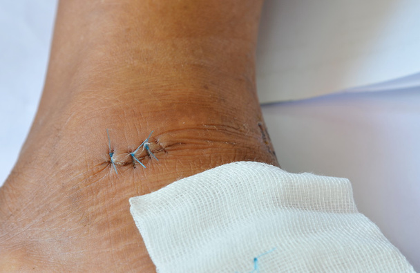 points de suture
. - Photo, image