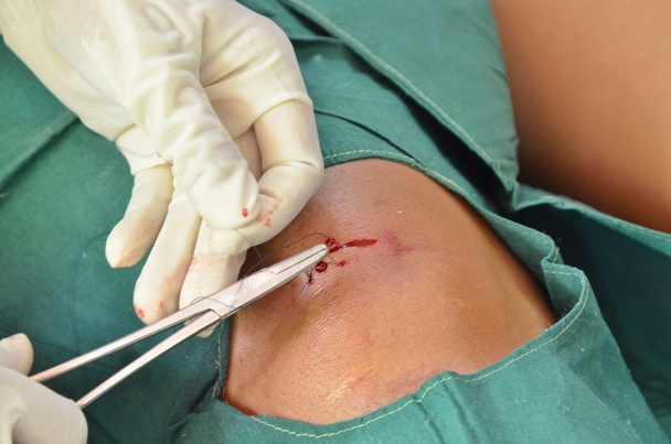 sutura da agulha de torção
. - Foto, Imagem