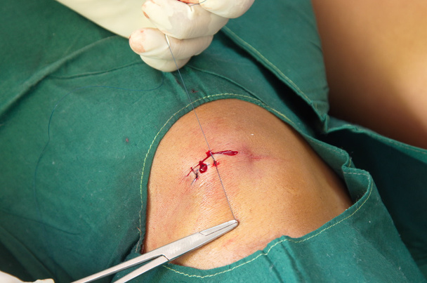 legare filo sutura ferita
. - Foto, immagini