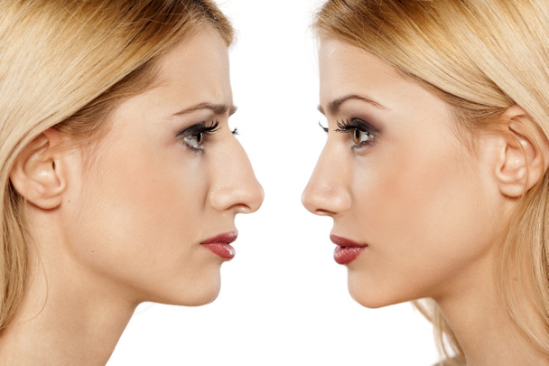 operace nosu před a po - Fotografie, Obrázek