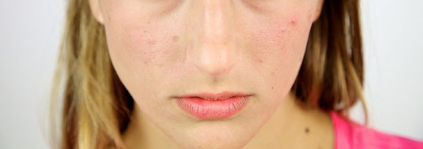 Pele facial de adolescente loiro com acne
 - Foto, Imagem