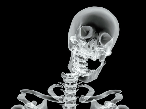Zdjęcie rentgenowskie złamanej kości wektor - Wektor, obraz