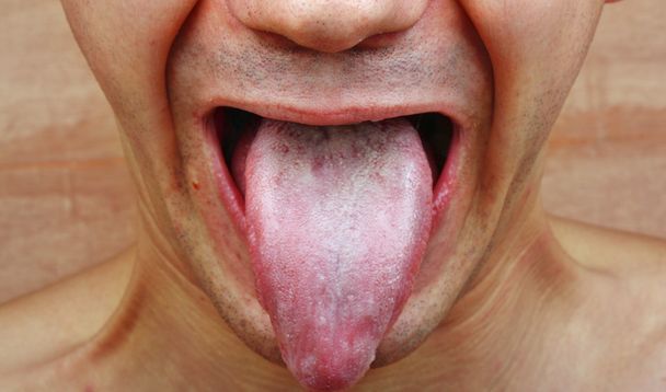 Infección lengua
  - Foto, imagen