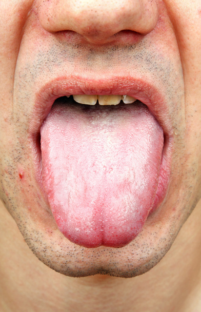 Bakteriyel bir enfeksiyon hastalığı dil - Fotoğraf, Görsel