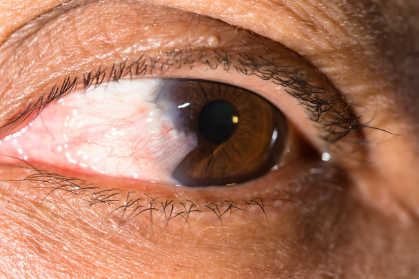examen oculaire, ptérygium à l'avance
 - Photo, image