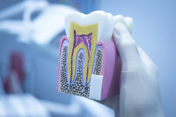 Modelo de dente dental elenco mostrando decadência raízes de esmalte
 - Foto, Imagem