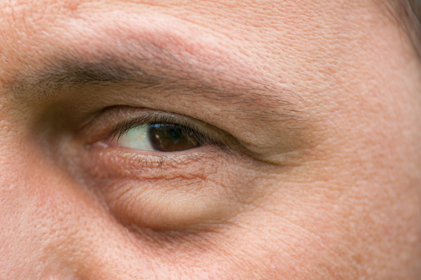 Augenschmerzen, Entzündungen oder Beutelschwellungen unter dem Auge - Foto, Bild