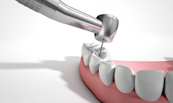 Dentisti trapano e denti
 - Foto, immagini
