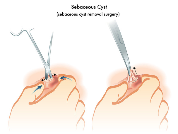 Human sebaceous cyst - Vector, Image