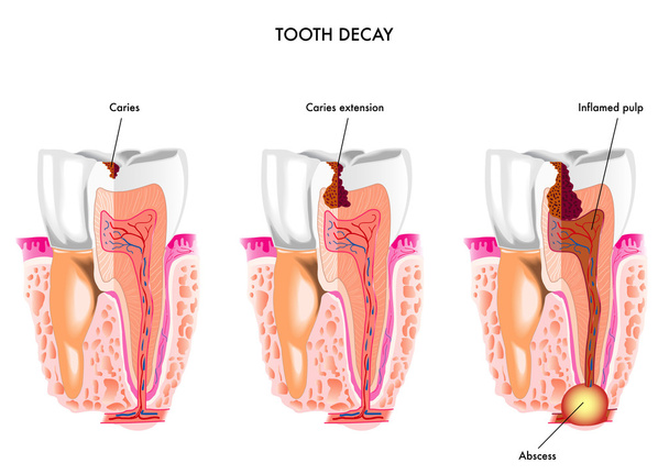 Tooth decay anatomy - Vektor, obrázek