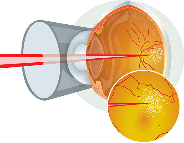 Cirugía ocular láser
 - Vector, Imagen