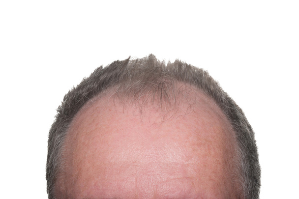 Male Pattern Baldness - Photo, Image