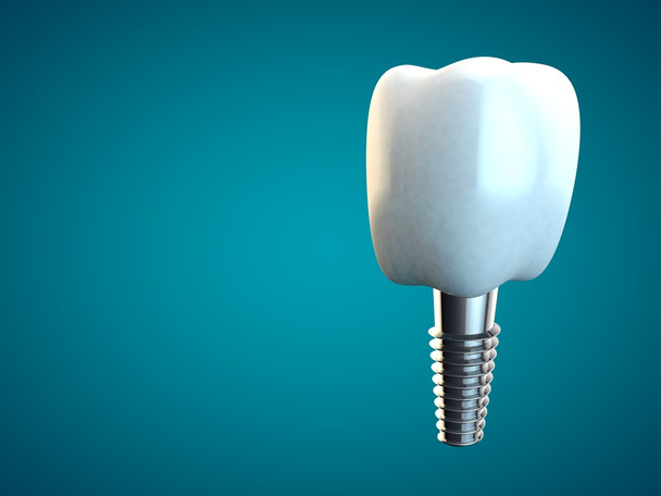 Tooth molar implant Dental Hygiene Dentist 3D blue - Fotografie, Obrázek