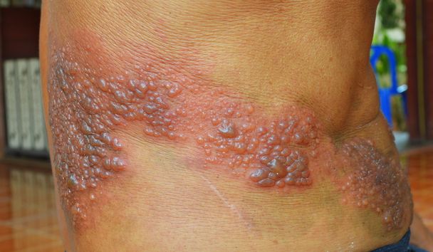 infection from  herpes zoster virus. - Φωτογραφία, εικόνα