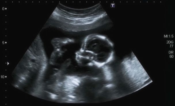 ultrasonografie analýza 4 měsíce plod - Fotografie, Obrázek