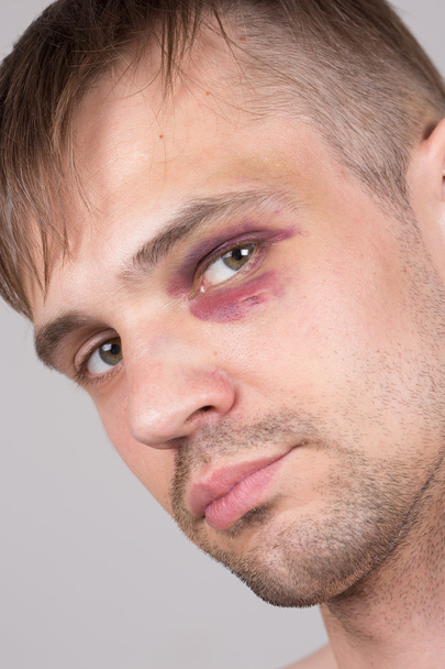 Man with an injured eye. Closeup. - 写真・画像