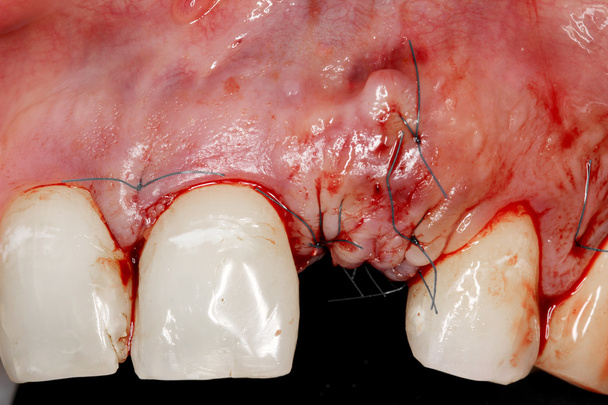 δοντιών εμφυτεύματος χειρουργική επέμβαση - Φωτογραφία, εικόνα